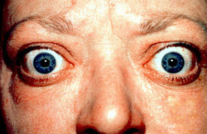 thyroid eye disease signs
